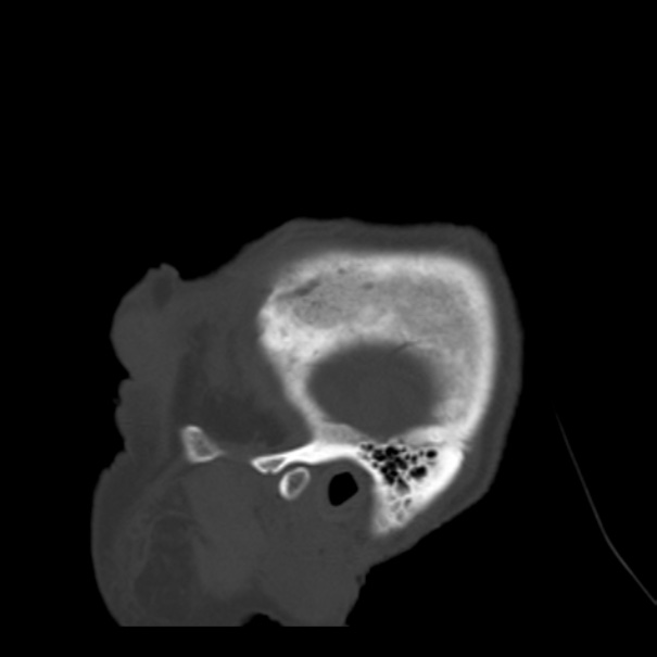 Biparietal osteodystrophy (Radiopaedia 46109-50463 Sagittal bone window 96).jpg