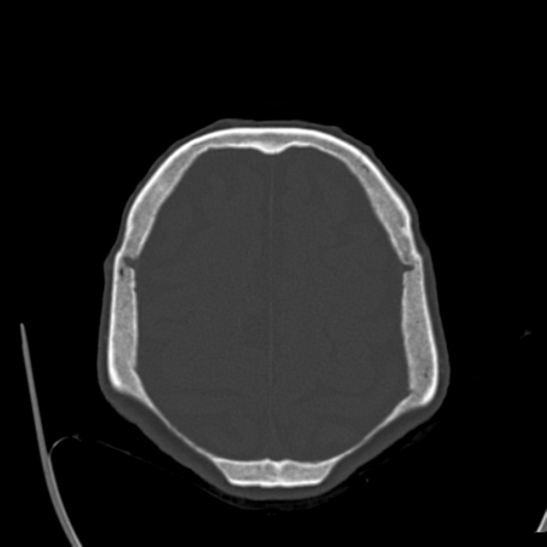Biparietal osteodystrophy (Radiopaedia 46109-50463 bone window 52).jpg