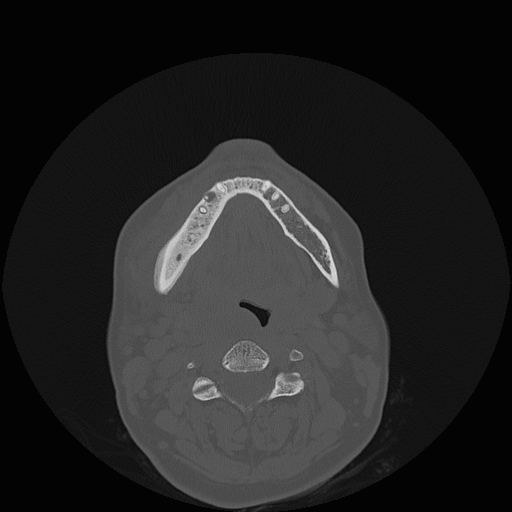 File:Bisphosphonate-related osteonecrosis of the jaw (Radiopaedia 71324-81642 Axial bone window 49).jpg