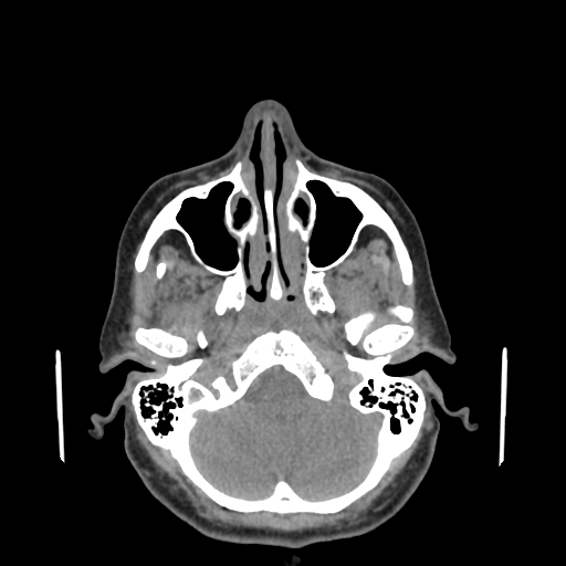 File:Bisphosphonate-related osteonecrosis of the jaw (Radiopaedia 71324-81642 non-contrast 146).jpg