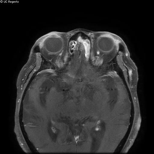 File:Bisphosphonate-related osteonecrosis of the maxilla (Radiopaedia 51367-57101 Axial T1 C+ fat sat 39).jpg