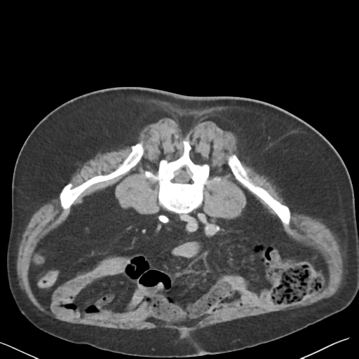 File:Bladder papillary urothelial carcinoma (Radiopaedia 48119-52951 Axial C+ delayed 34).png