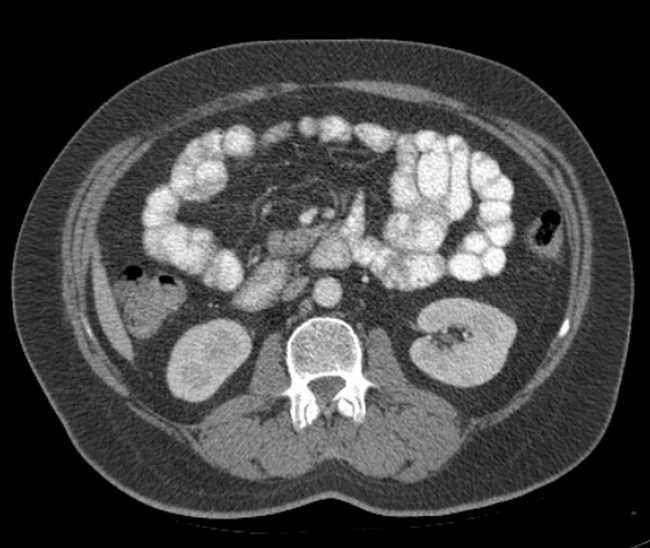 File:Bleeding duodenal ulcer and adenomyomatosis of gallbladder (Radiopaedia 61834-69861 A 57).jpg