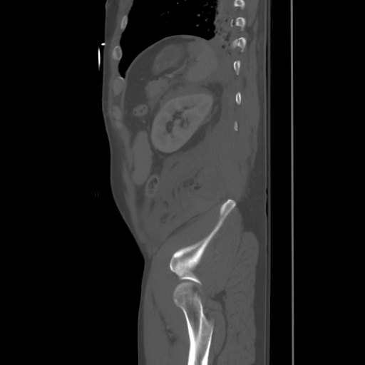 Blunt abdominal trauma with solid organ and musculoskelatal injury with active extravasation (Radiopaedia 68364-77895 Sagittal bone window 89).jpg