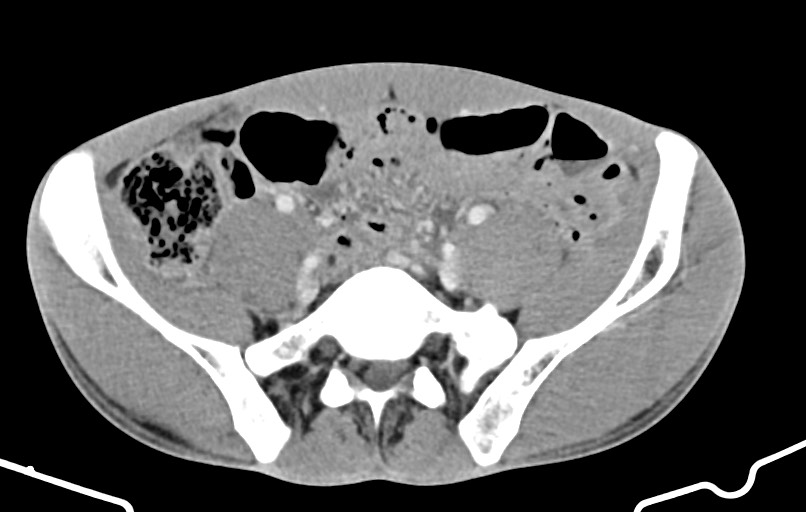 Blunt injury to the small bowel (Radiopaedia 74953-85987 A 139).jpg