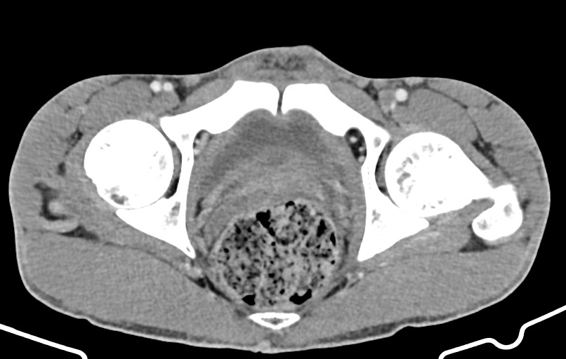 Blunt injury to the small bowel (Radiopaedia 74953-85987 A 187).jpg