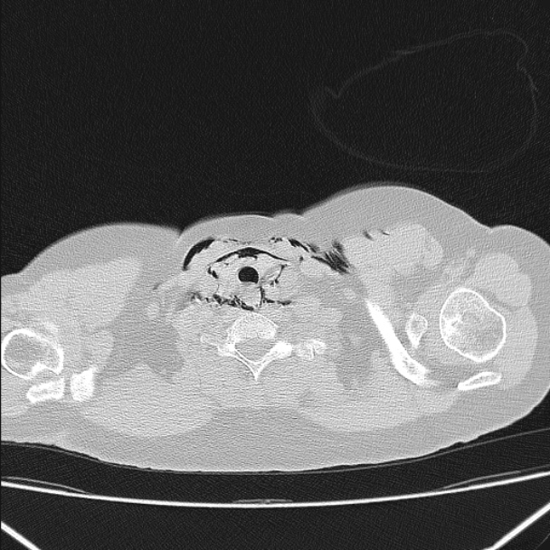 Boerhaave syndrome (Radiopaedia 45644-49799 Axial lung window 22).jpg