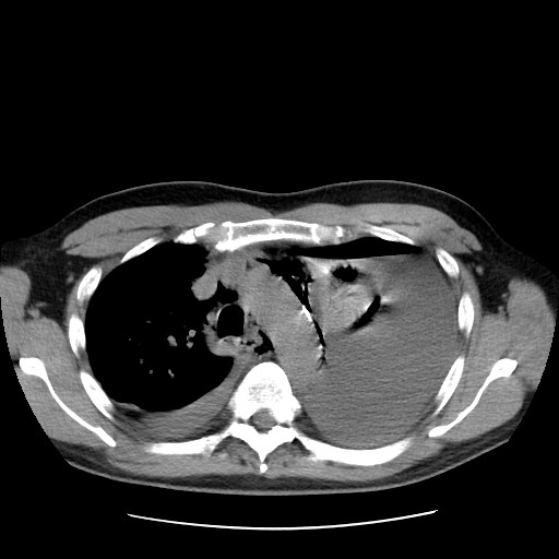 Boerhaave syndrome (Radiopaedia 59796-67310 Axial liver window 22).jpg