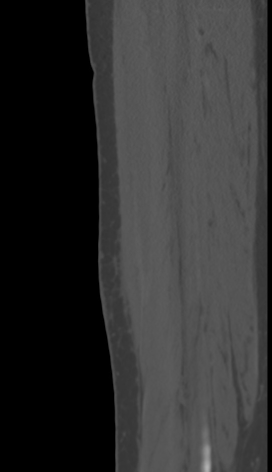 Bone metastasis - tibia (Radiopaedia 57665-64609 Sagittal bone window 136).jpg