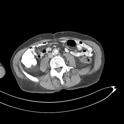 Bone metastasis from squamous cell carcinoma (Radiopaedia 30133-30730 B 43).jpg