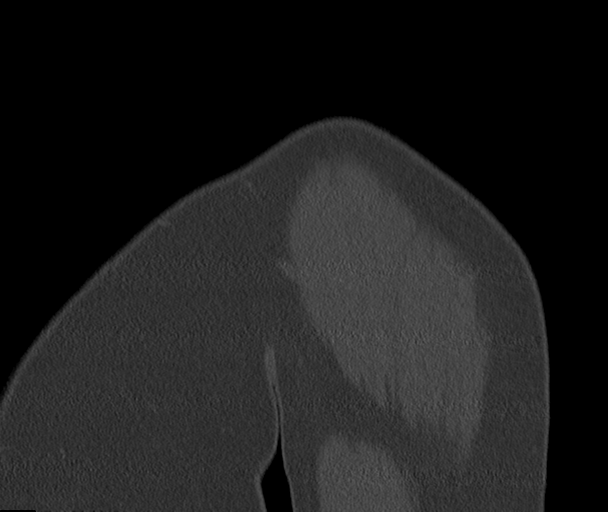 Bony Bankart and Hill-Sachs lesions (Radiopaedia 33622-34727 Sagittal bone window 6).png