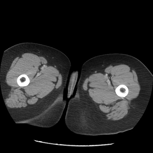 File:Borderline mucinous tumor (ovary) (Radiopaedia 78228-90808 A 152).jpg