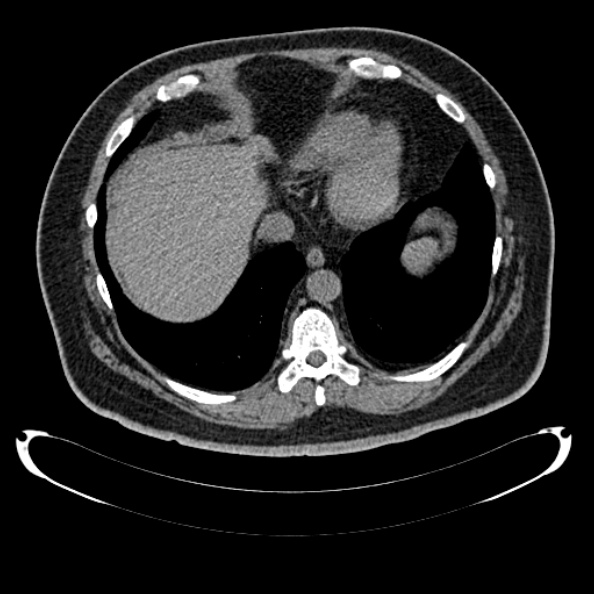 Bosniak renal cyst - type IV (Radiopaedia 24244-24518 Axial non-contrast 35).jpg