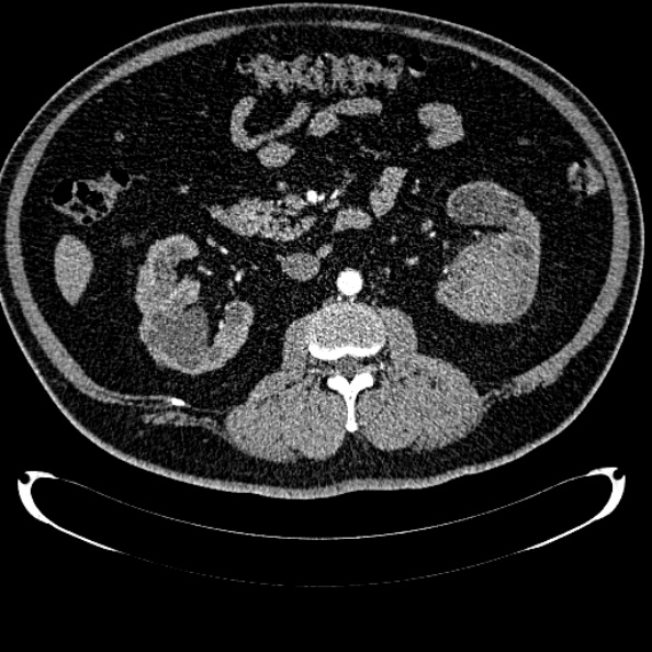 File:Bosniak renal cyst - type IV (Radiopaedia 24244-24518 B 159).jpg
