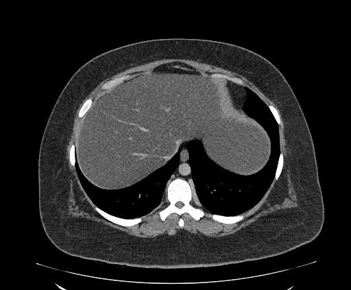 Bowel and splenic infarcts in acute lymphocytic leukemia (Radiopaedia 61055-68913 A 22).jpg