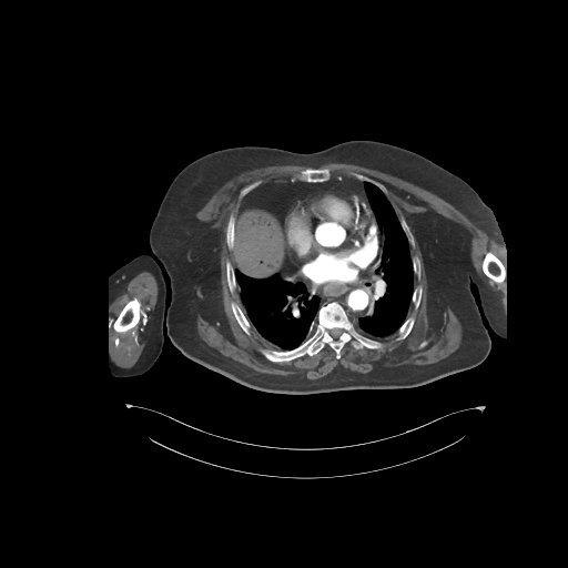File:Bowel ischemia secondary to SMA occlusion with extensive portomesenteric venous gas (Radiopaedia 54656-60871 A 79).jpg