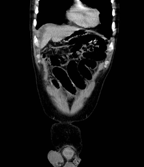 Bowel obstruction from colon carcinoma (Radiopaedia 22995-23028 C 11).jpg