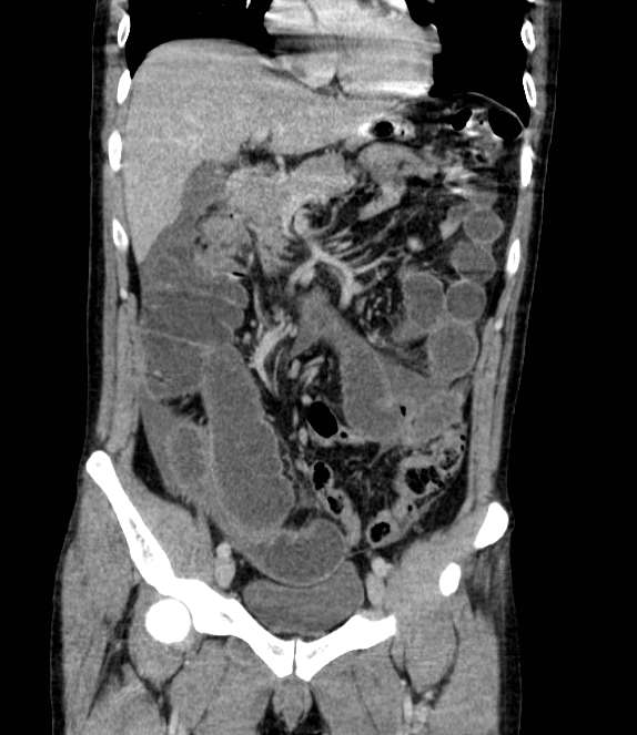 Bowel obstruction from colon carcinoma (Radiopaedia 22995-23028 C 29).jpg