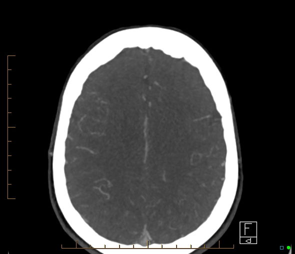 Brachiocephalic trunk stenosis (Radiopaedia 87242-103519 A 20).jpg
