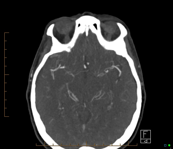 Brachiocephalic trunk stenosis (Radiopaedia 87242-103519 A 39).jpg