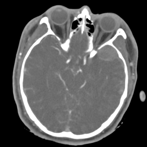 File:Brain contusions, internal carotid artery dissection and base of skull fracture (Radiopaedia 34089-35339 D 33).png