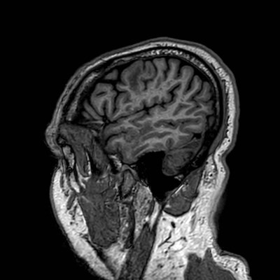 Brain metastases from lung cancer (Radiopaedia 83839-99028 Sagittal T1 111).jpg
