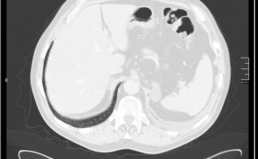 Brain metastases from squamocellular lung cancer (Radiopaedia 56515-63219 Axial lung window 60).jpg