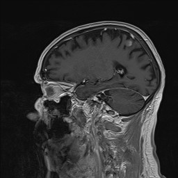 Brain metastasis (Radiopaedia 42617-45761 Sagittal T1 C+ 65).jpg