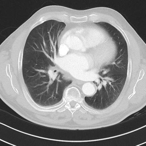 Brain metastasis (large cystic mass) (Radiopaedia 47497-52104 Axial lung window 25).png