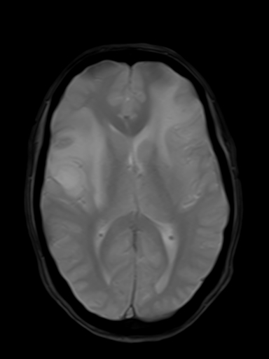 File:Brain metastasis as initial presentation of non-small cell lung cancer (Radiopaedia 65122-74126 Axial T2* 11).jpg