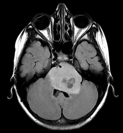 File:Brainstem glioma (Radiopaedia 9444-10124 Axial FLAIR 1).jpg