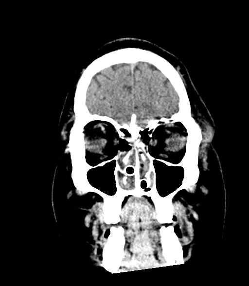 Brainstem hemorrhage (Radiopaedia 81294-94976 Coronal non-contrast 11).jpg