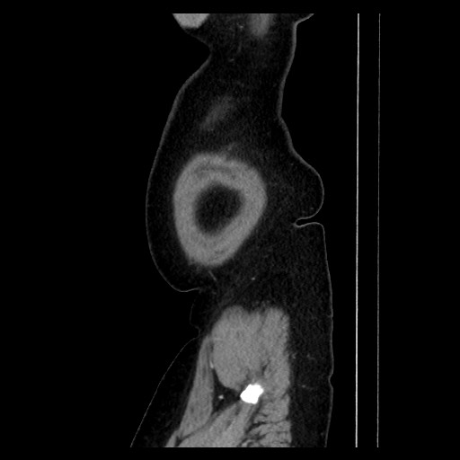 Breast cancer pseudocirrhosis with lobar invovlement (Radiopaedia 81080-94670 D 191).jpg