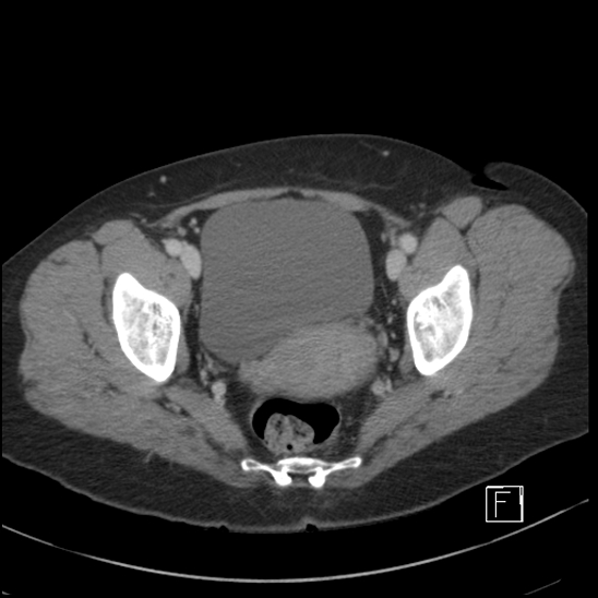 File:Breast metastases from renal cell cancer (Radiopaedia 79220-92225 C 105).jpg
