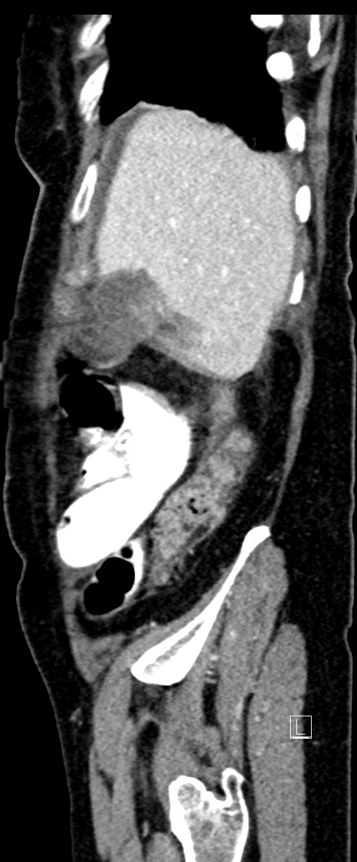 Broad ligament hernia (Radiopaedia 84802-100276 C 72).jpg