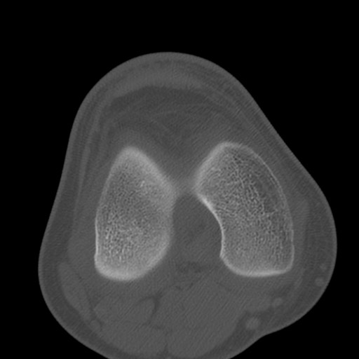 Brodie abscess of the tibia (Radiopaedia 58984-66250 Axial bone window 48).jpg