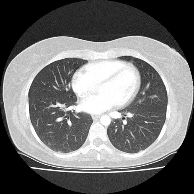 Bronchial atresia (Radiopaedia 22965-22992 Axial lung window 22).jpg