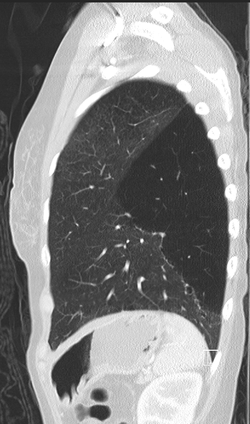 Bronchial atresia (Radiopaedia 73677-84470 Sagittal lung window 44).jpg