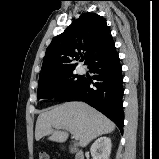Bronchial carcinoid tumor (Radiopaedia 67377-76764 E 26).jpg