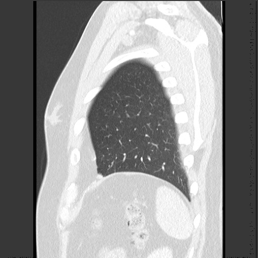 Bronchial carcinoid tumor (Radiopaedia 67377-76764 Sagittal lung window 59).jpg