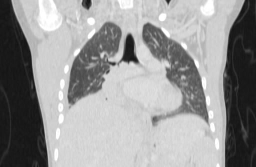 Bronchial mucoepidermoid carcinoma (Radiopaedia 57023-63895 Coronal lung window 14).jpg