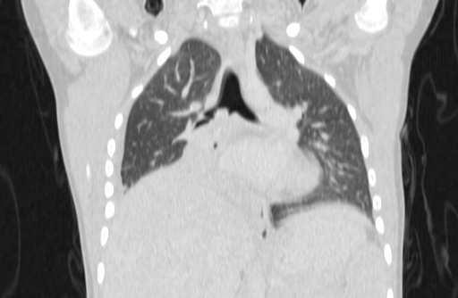 Bronchial mucoepidermoid carcinoma (Radiopaedia 57023-63895 Coronal lung window 18).jpg