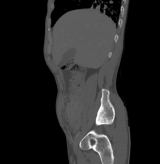 Bronchiectasis in Crohn disease (Radiopaedia 60311-67977 Sagittal bone window 47).jpg
