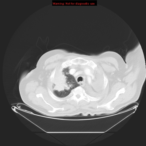File:Bronchioloalveolar carcinoma (Radiopaedia 9272-9955 Axial lung window 5).jpg