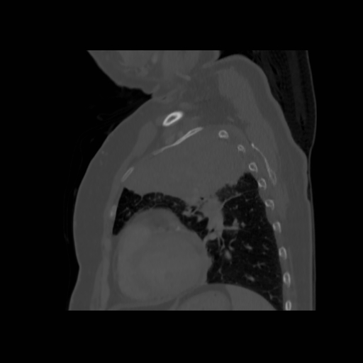 File:Bronchogenic carcinoma (Radiopaedia 73497-84262 Sagittal bone window 111).jpg
