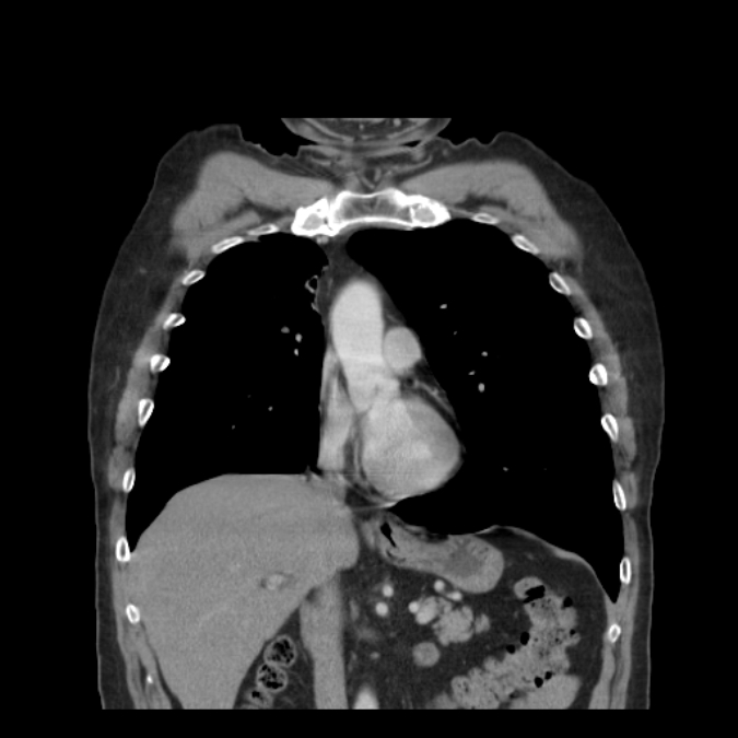 Bronchogenic carcinoma with upper lobe collapse (Radiopaedia 29297-29726 D 25).jpg