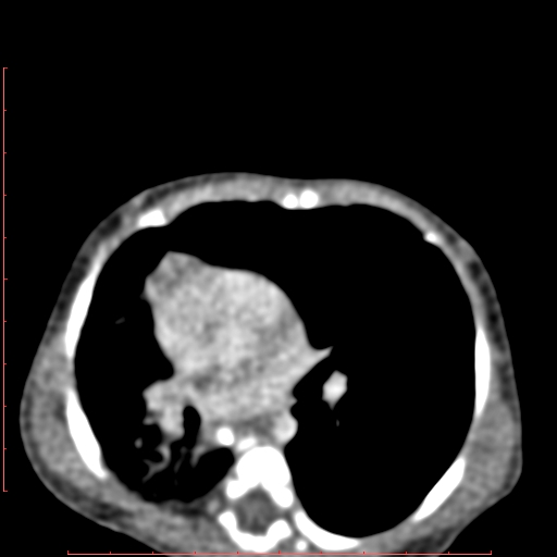 Bronchogenic cyst (Radiopaedia 78599-91409 B 105).jpg