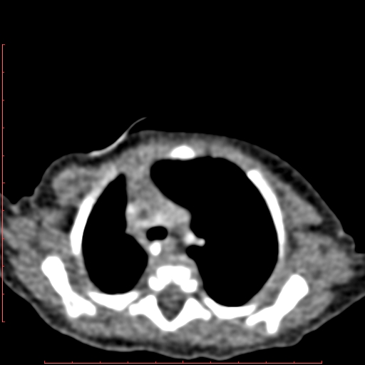 Bronchogenic cyst (Radiopaedia 78599-91409 B 59).jpg