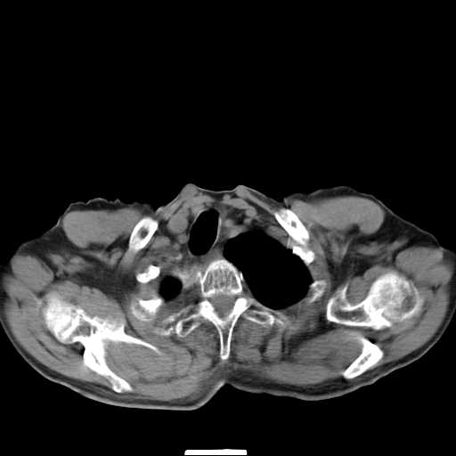 File:Bronchopleural fistula - postoperative complication (Radiopaedia 21020-20947 Axial non-contrast 2).jpg