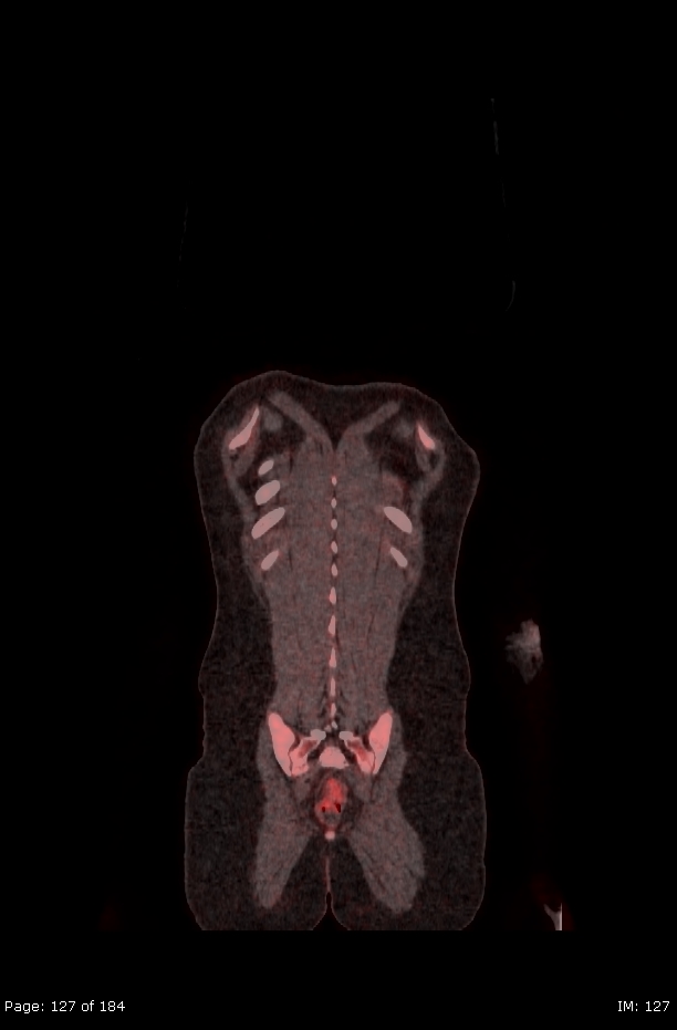Brown fat uptake (FDG PET-CT) (Radiopaedia 77392-89513 Fused coronal 85).jpg